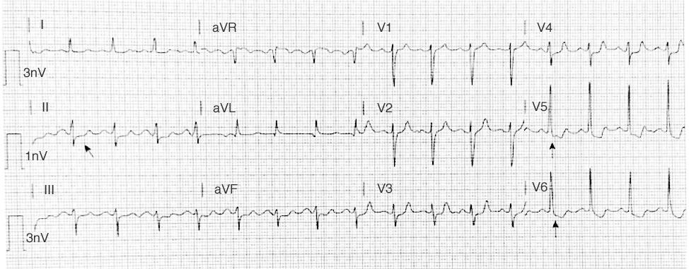 ecg